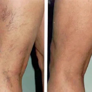 Spider Vein Treatment (Sclerotherapy) Package (3)